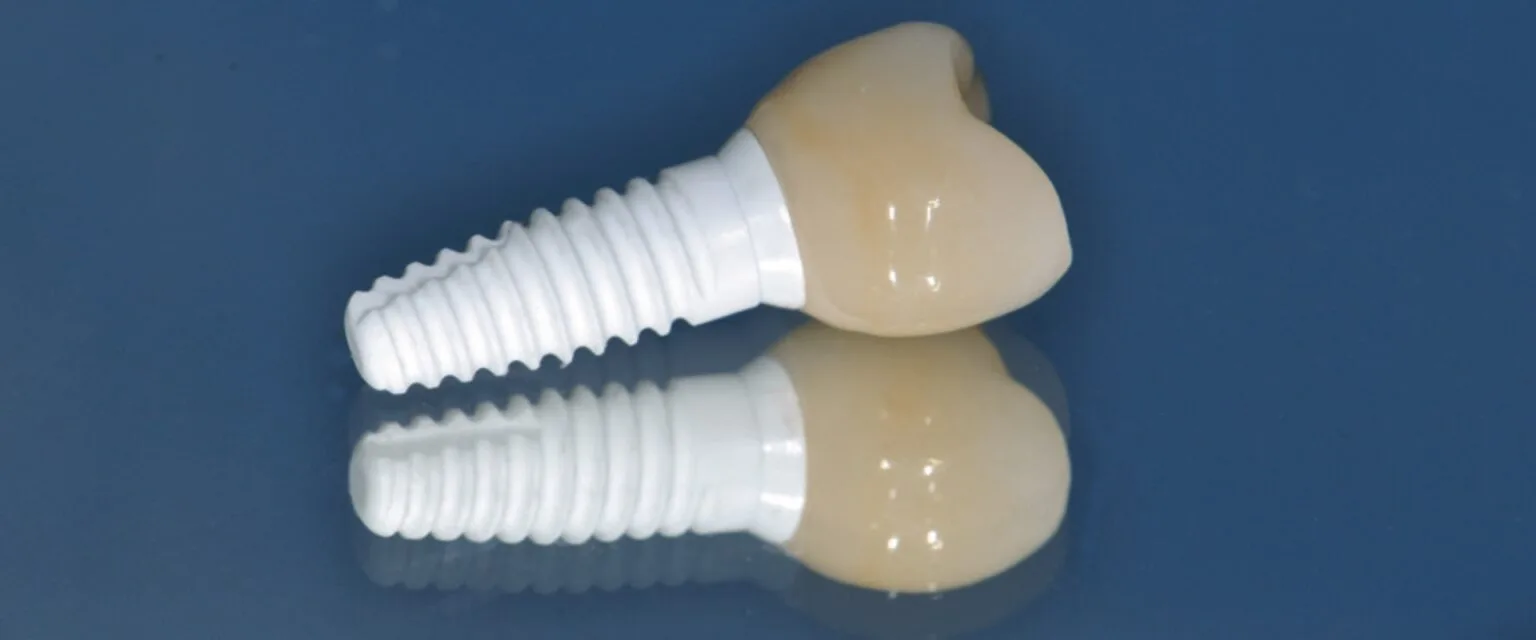 Dental implants