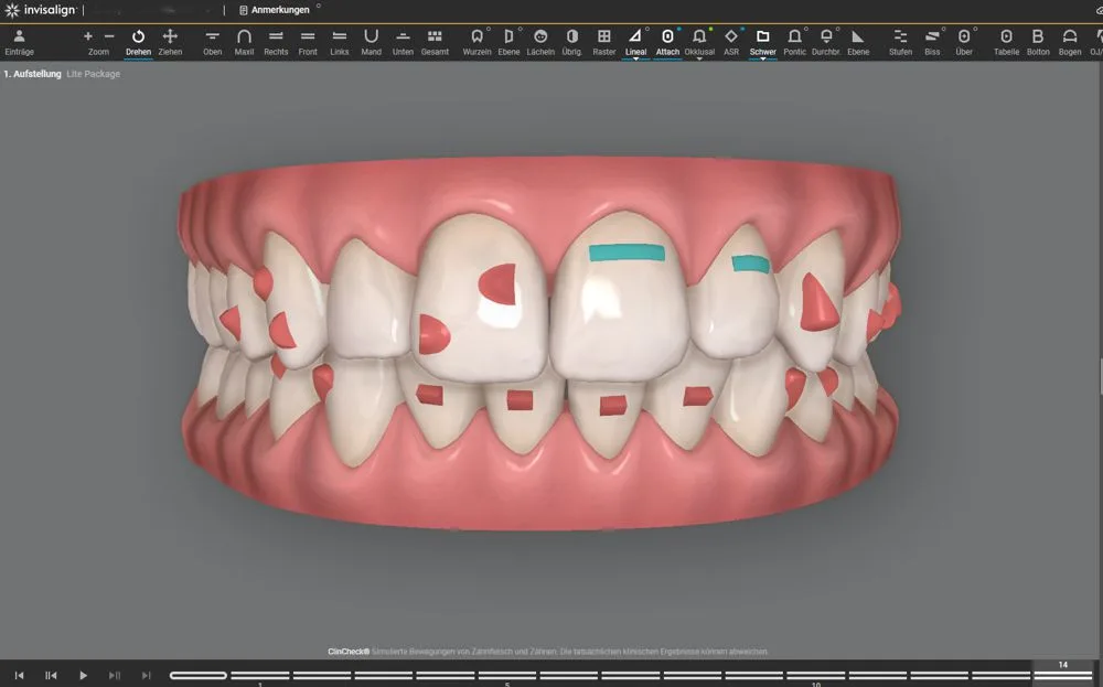 Zahnstellung nach der Invisalign-Behandlung, Zahnarztpraxis Kilchberg