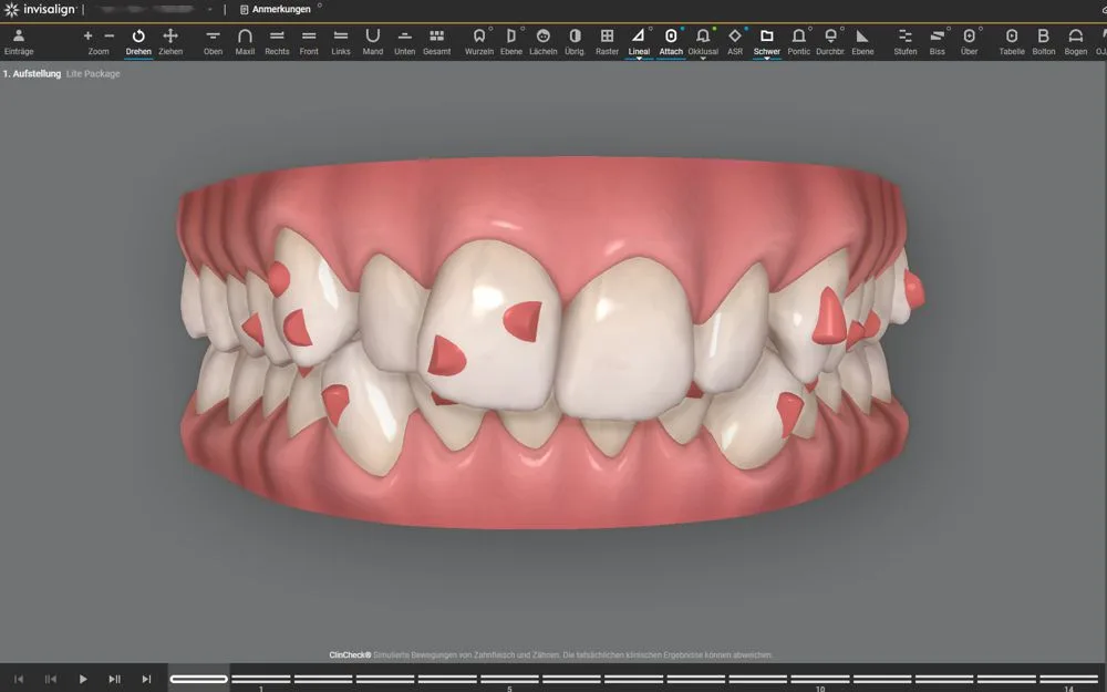 Zahnstellung vor der Invisalign-Behandlung, Zahnarztpraxis Kilchberg